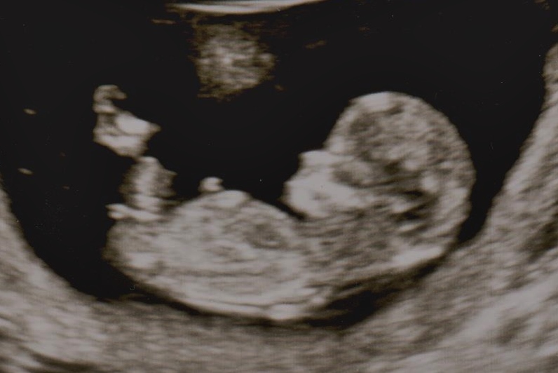 Name:  Baby #3 ultrasound.jpg
Views: 28172
Size:  133.7 KB