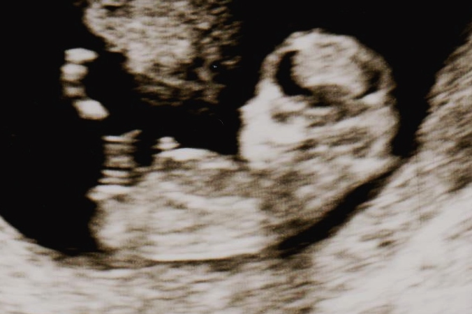 Name:  Baby #3 ultrasound b.jpg
Views: 174
Size:  131.9 KB