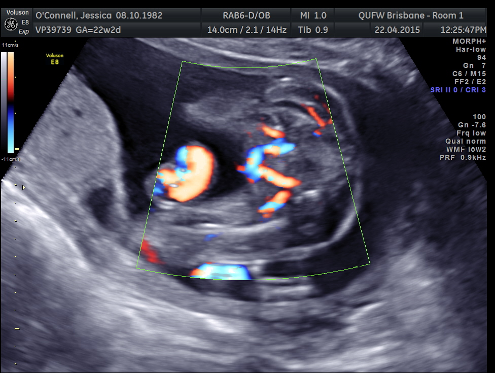 Name:  Bub #4 100.jpg
Views: 373
Size:  273.8 KB