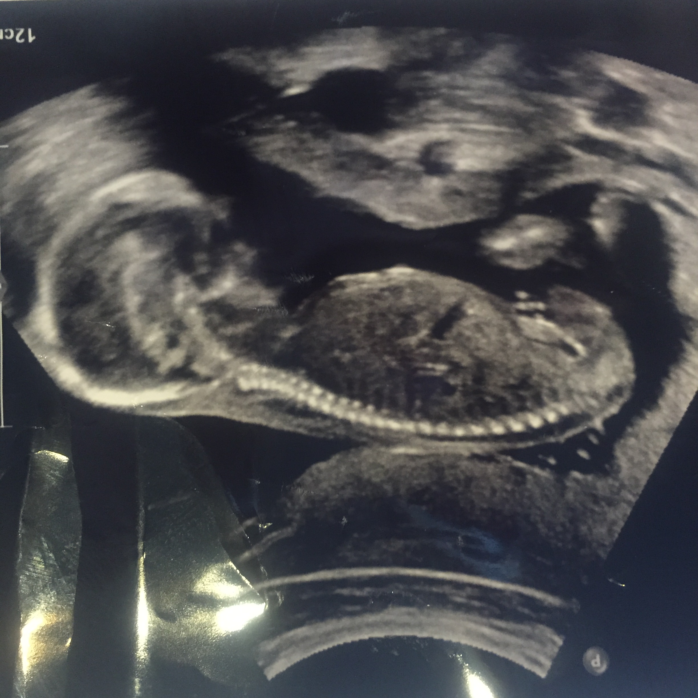Name:  17.6 Weeks (1).jpg
Views: 562
Size:  912.6 KB