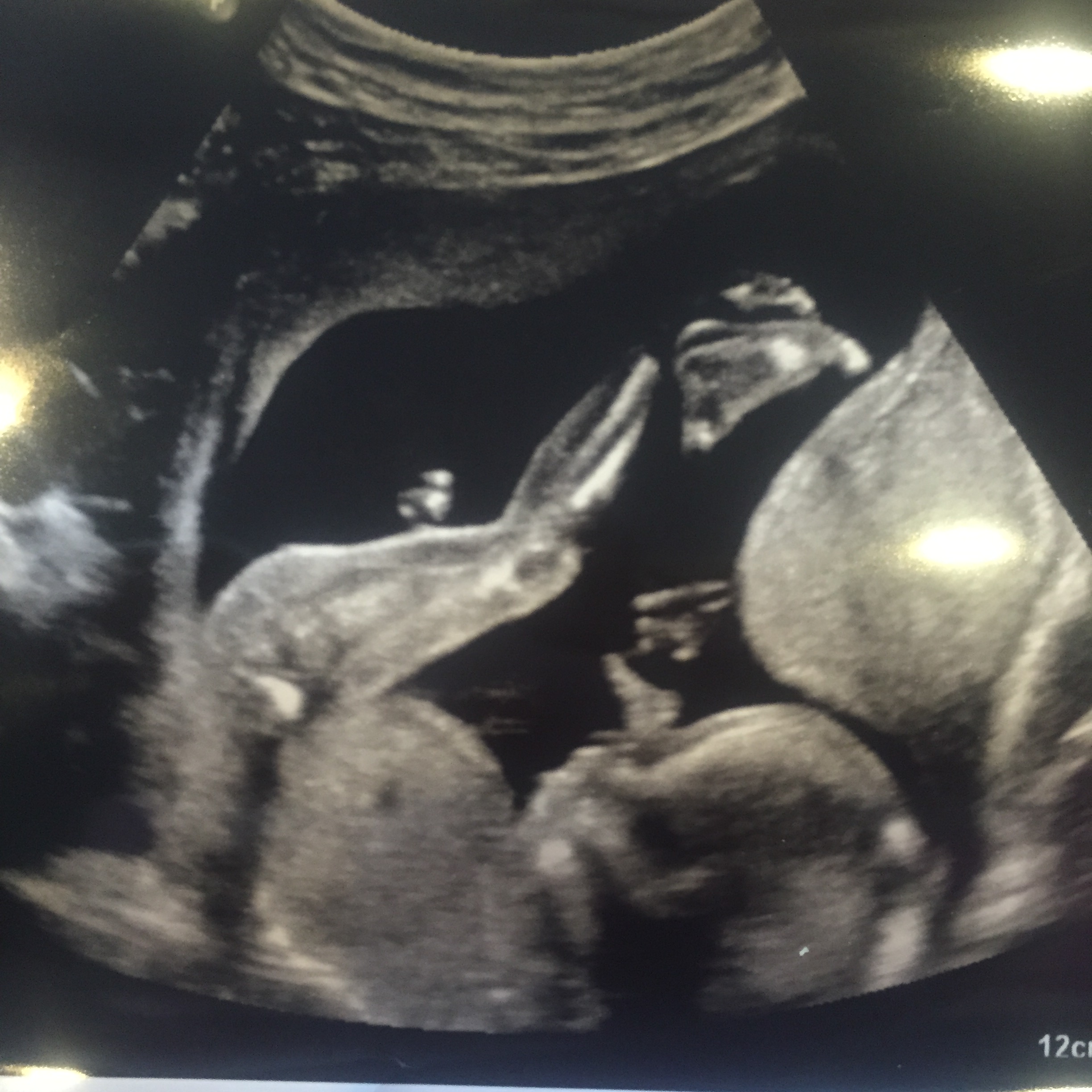 Name:  17.6 Weeks (2).jpg
Views: 750
Size:  816.4 KB