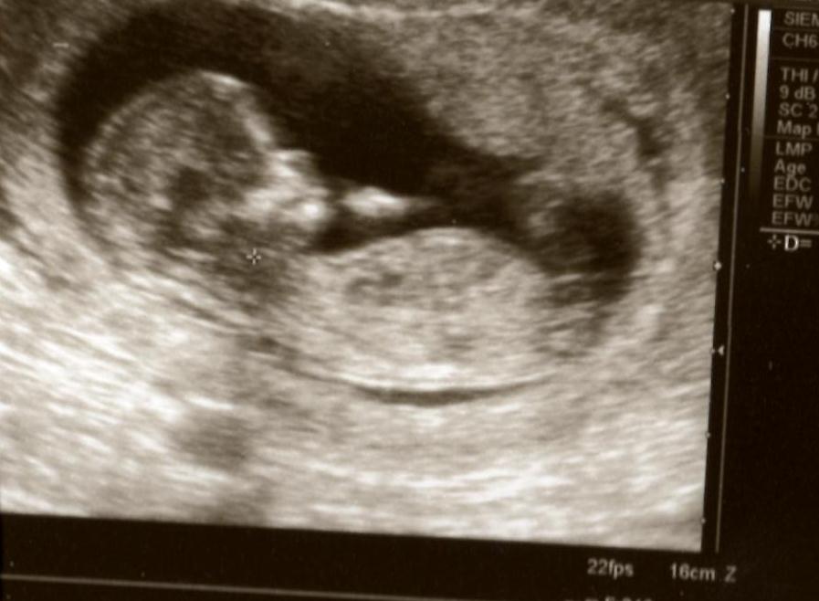 Name:  12 weeks 3 days.jpg
Views: 208
Size:  54.5 KB