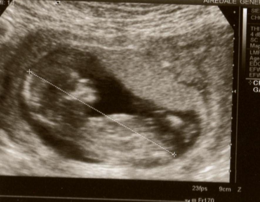 Name:  12 weeks 3 days H.jpg
Views: 181
Size:  60.9 KB