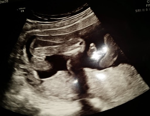 Name:  baby3_20weeksa.jpg
Views: 1561
Size:  129.4 KB