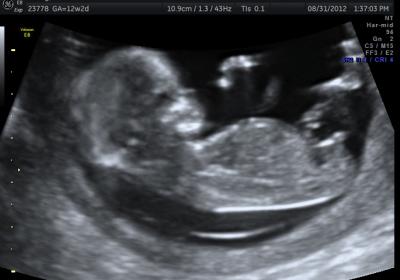 Name:  ultrasound.jpg
Views: 3314
Size:  15.2 KB