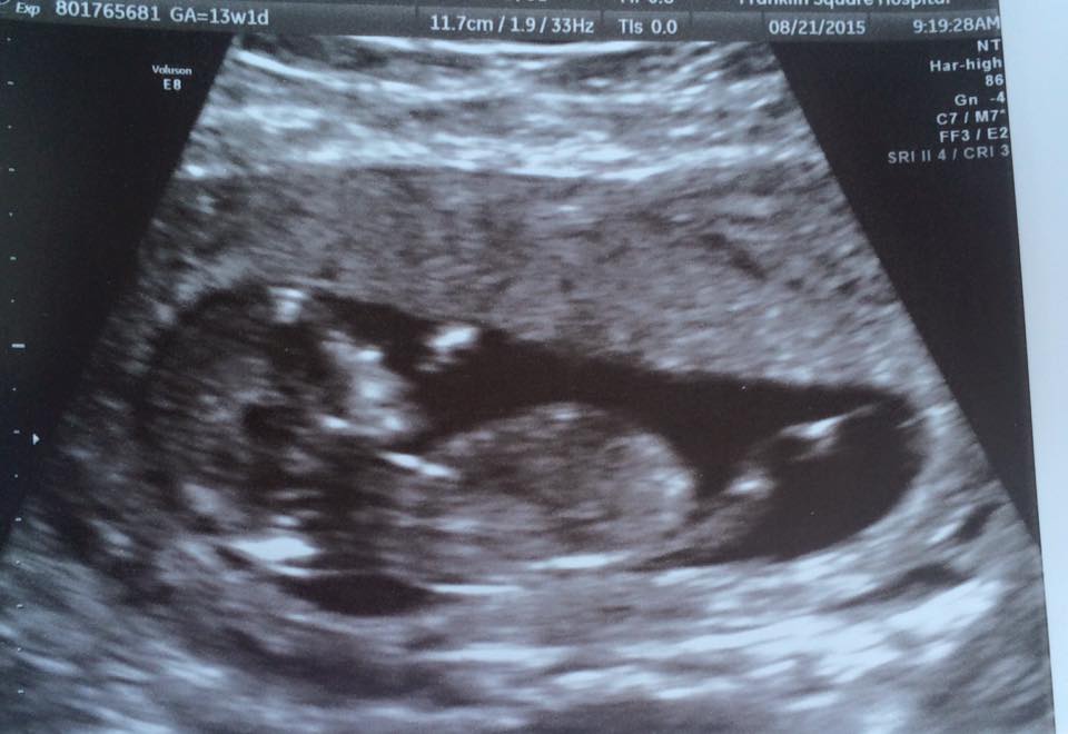 Name:  ultrasound.jpg
Views: 12299
Size:  60.5 KB
