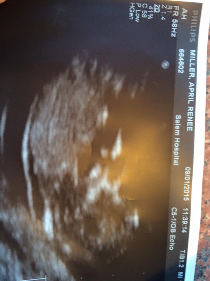 Name:  12w ultrasound.jpg
Views: 159
Size:  66.3 KB