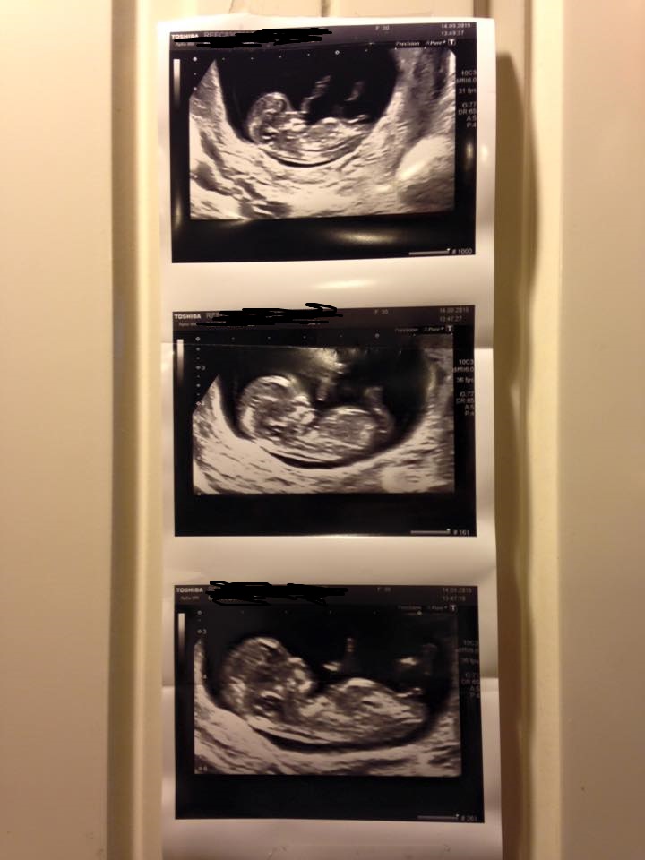 Name:  baby scan p.jpg
Views: 200
Size:  97.8 KB