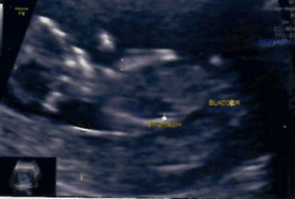 Name:  12W- bladder.jpg
Views: 138
Size:  12.4 KB