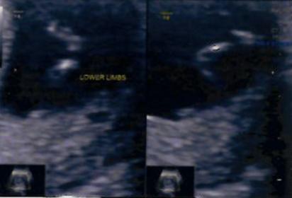 Name:  12W-lower limbs.jpg
Views: 144
Size:  11.7 KB