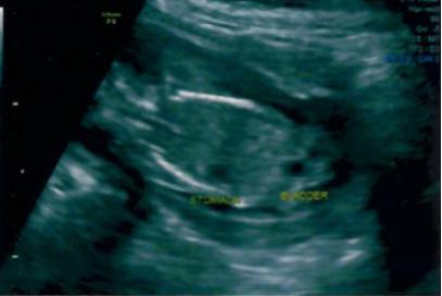 Name:  16W-Bladder.jpg
Views: 177
Size:  12.3 KB