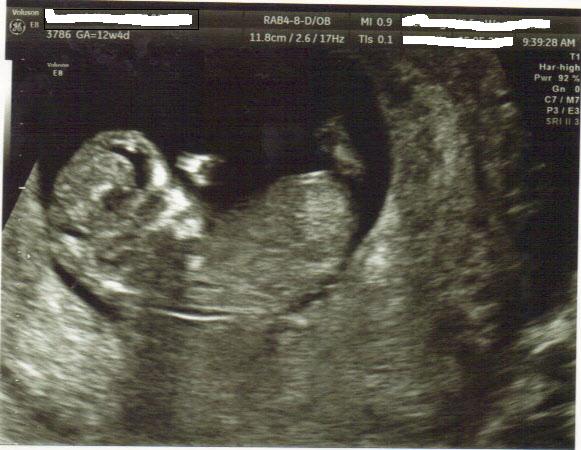 Name:  Ultrasound photo.jpg
Views: 279
Size:  44.9 KB