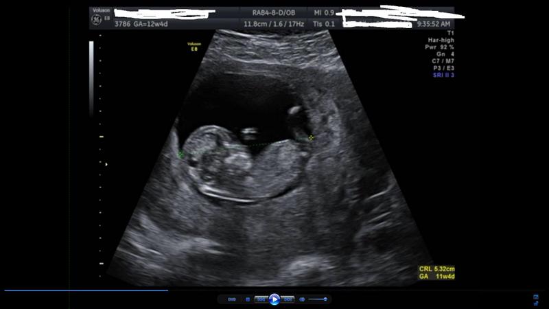 Name:  ultrasound video1.jpg
Views: 289
Size:  30.8 KB