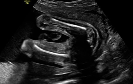 Name:  Baby Gender 13 cropped.jpg
Views: 130
Size:  32.8 KB