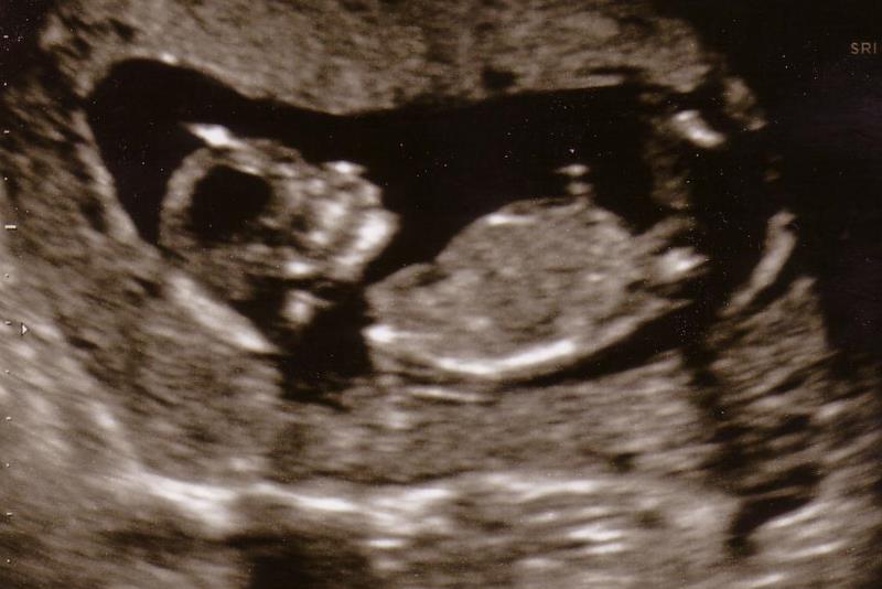Name:  US NT 12 weeks.JPG
Views: 148
Size:  54.9 KB