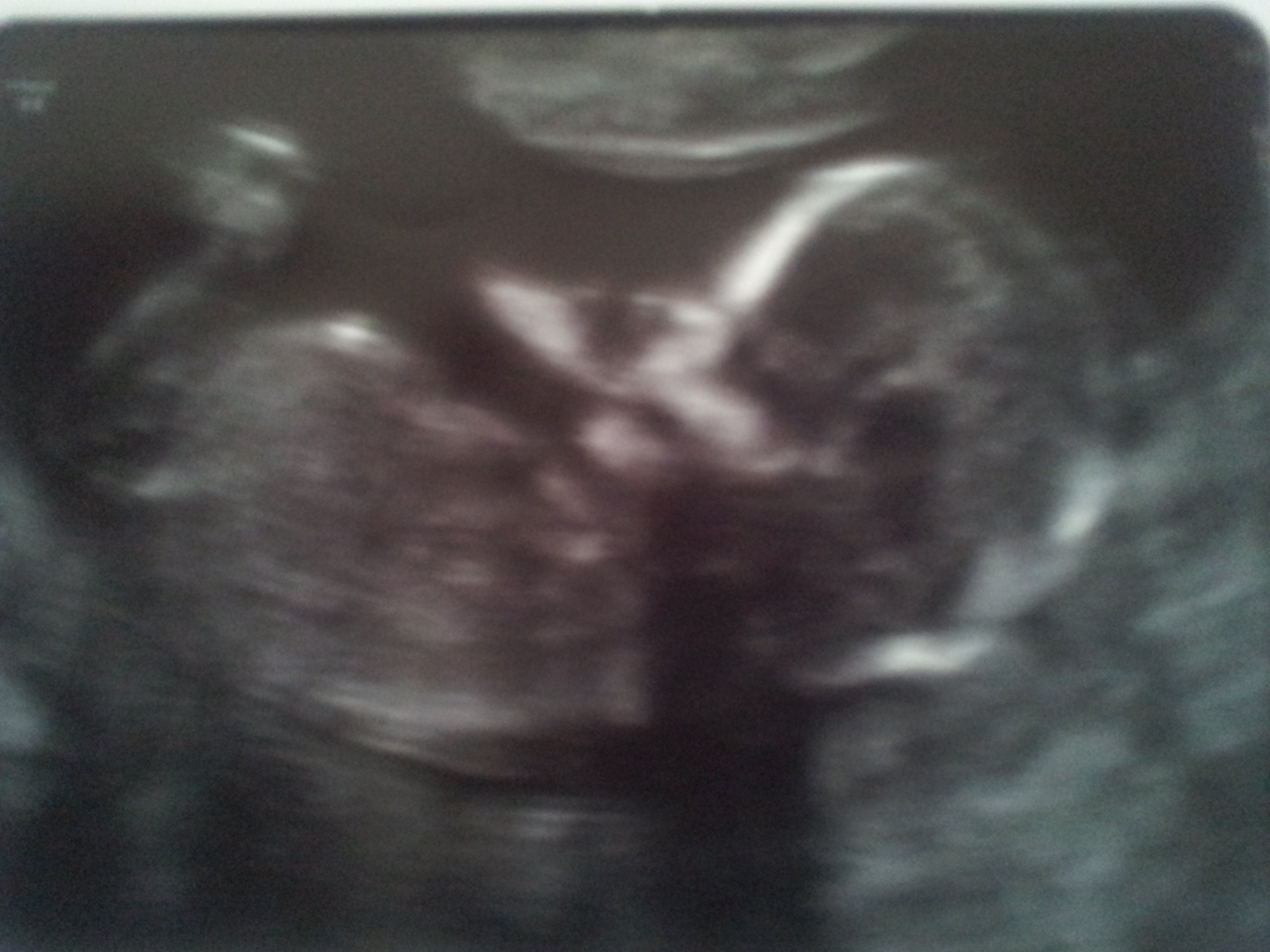 Name:  Baby Number 4 @ 13w 5d.jpg
Views: 425
Size:  1.22 MB