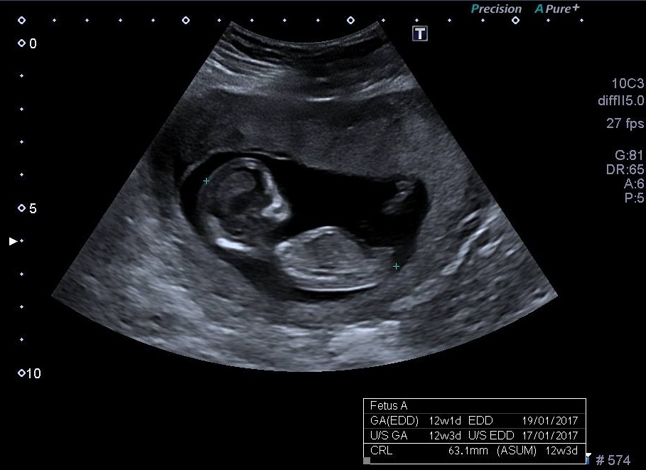 Name:  12 wks NUB.jpg
Views: 513
Size:  118.3 KB