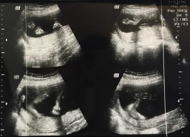 Name:  ultrasound scan.jpg
Views: 297
Size:  18.4 KB