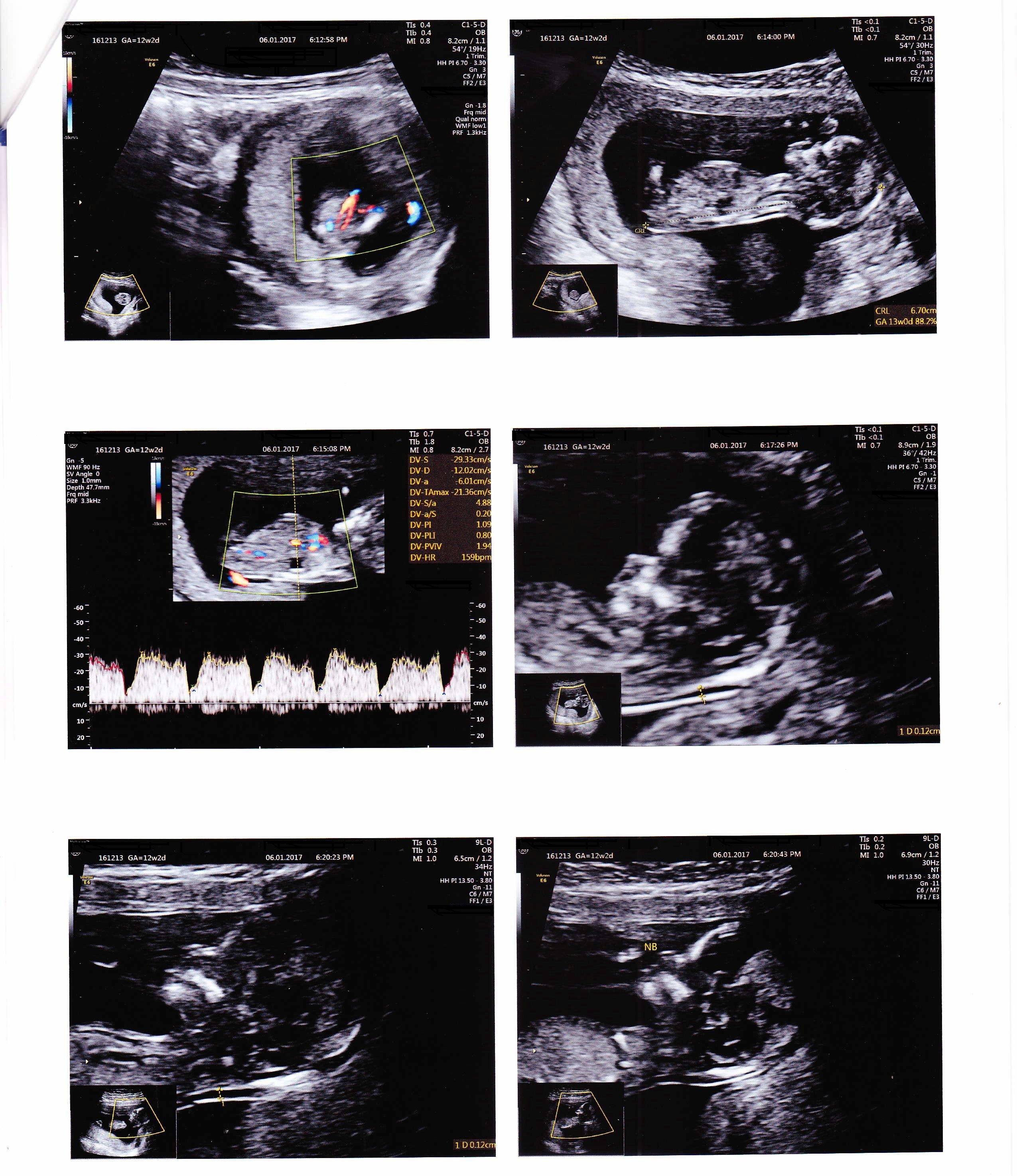 Name:  2nd scan report - 12W+2D - 06012016-page-001.jpg
Views: 870
Size:  1.57 MB