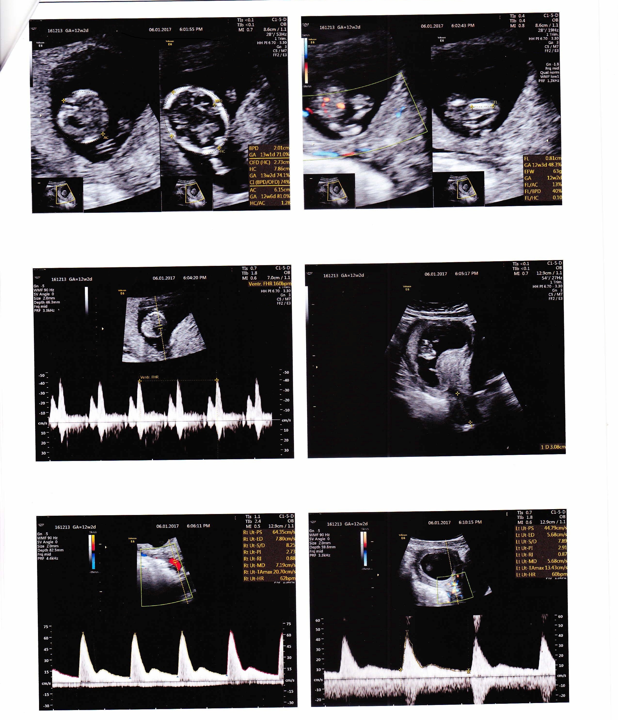 Name:  2nd scan report - 12W+2D - 06012016-page-002.jpg
Views: 565
Size:  1.60 MB