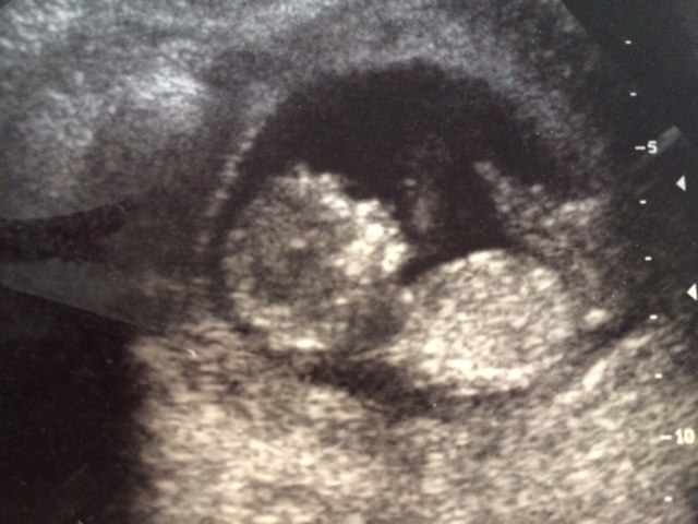Name:  13 week scan.jpg
Views: 94
Size:  97.0 KB