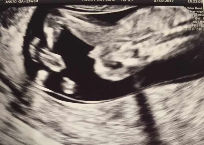 Name:  Ultraschallbild 1.jpg
Views: 234
Size:  128.8 KB