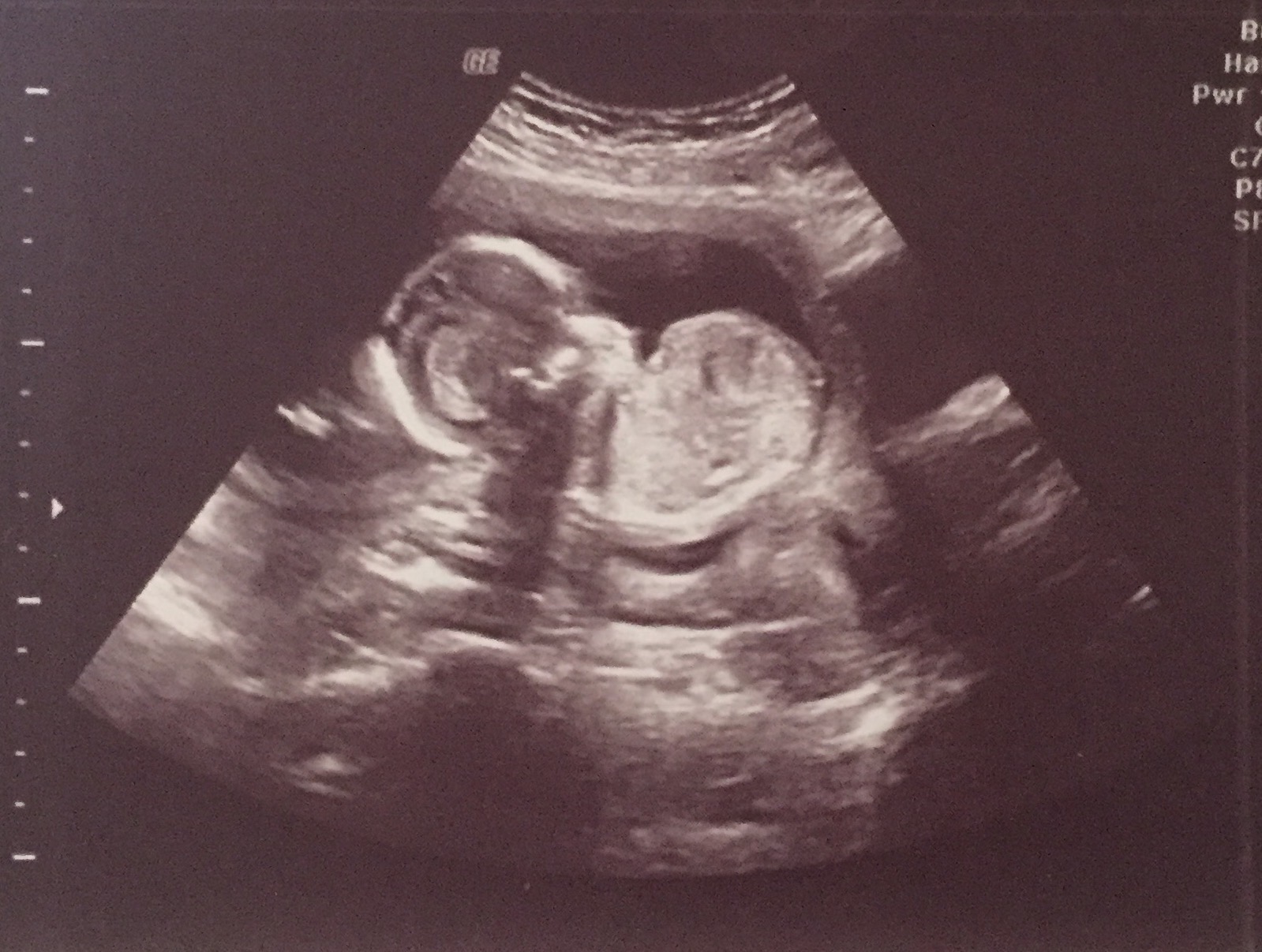 Name:  ultrasound2.jpg
Views: 356
Size:  371.9 KB