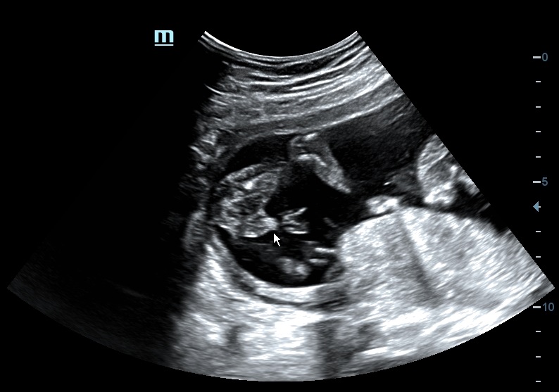 Name:  Ultrasound 1.jpg
Views: 586
Size:  92.3 KB