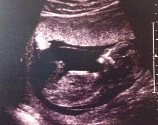Name:  Baby 12 Weeks.jpg
Views: 655
Size:  29.9 KB