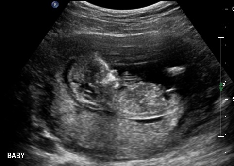 Name:  OBSTETRIC ULTRASOUND 0004.jpg
Views: 412
Size:  48.4 KB