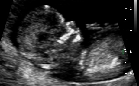 Name:  OBSTETRIC ULTRASOUND 0006.jpg
Views: 350
Size:  31.6 KB