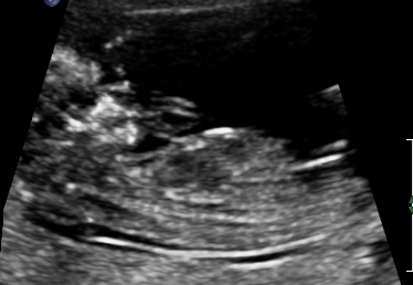 Name:  OBSTETRIC ULTRASOUND 0010.jpg
Views: 276
Size:  25.2 KB