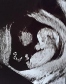 Name:  baby scan 2.jpg
Views: 226
Size:  10.0 KB