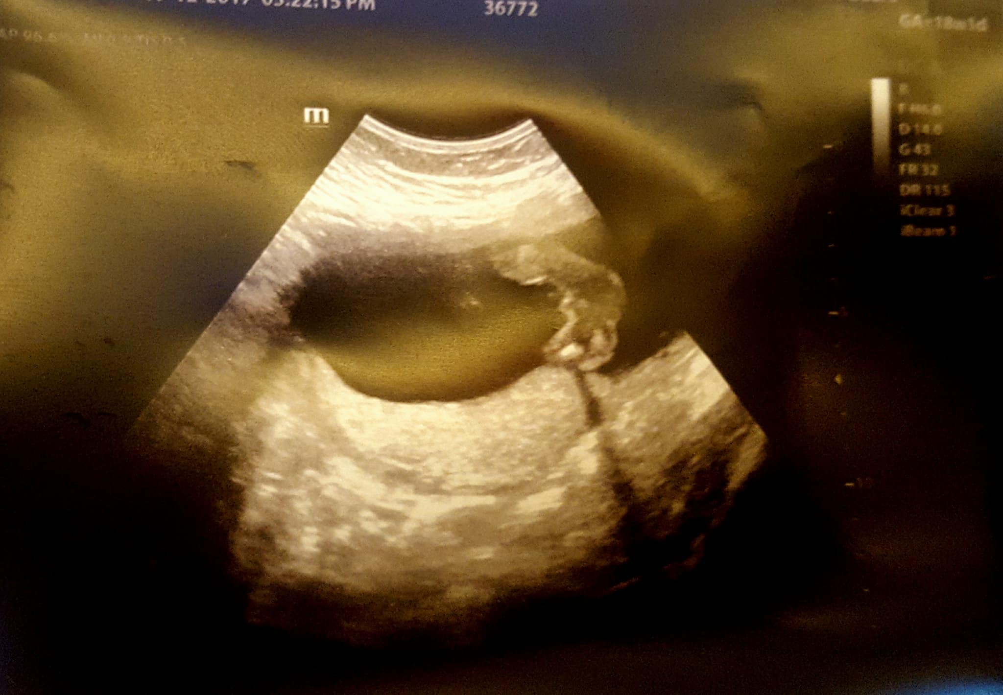Name:  18weeks.jpg
Views: 271
Size:  162.8 KB