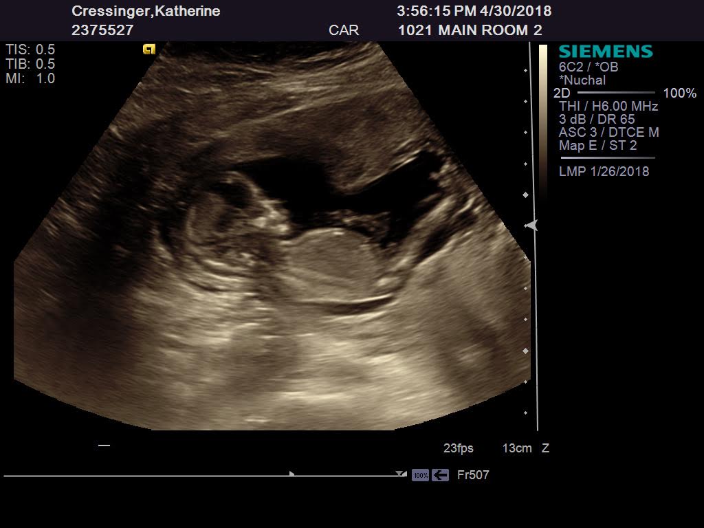 Name:  ultra sound 1.jpg
Views: 112
Size:  64.9 KB