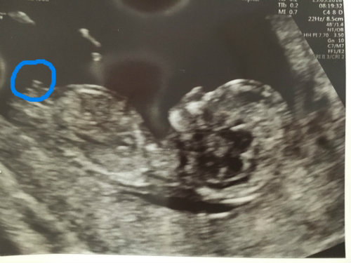 Name:  39591d152734401-nub-experts-help-my-12-week-scan-peanut-3-jpg.jpg
Views: 380
Size:  36.7 KB