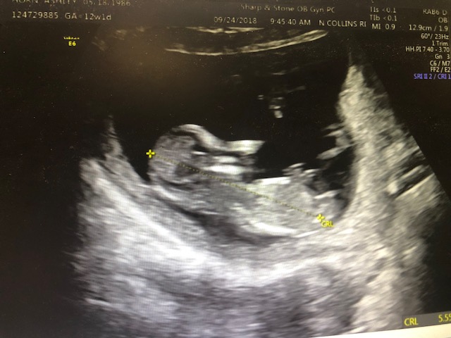 Name:  Ultrasound Pic 2.jpg
Views: 386
Size:  74.4 KB