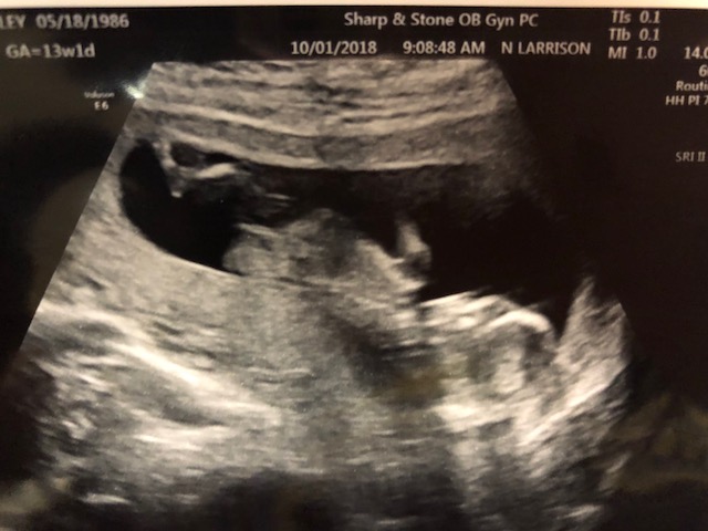 Name:  Ultrasound 10-1-18.jpg
Views: 209
Size:  71.1 KB