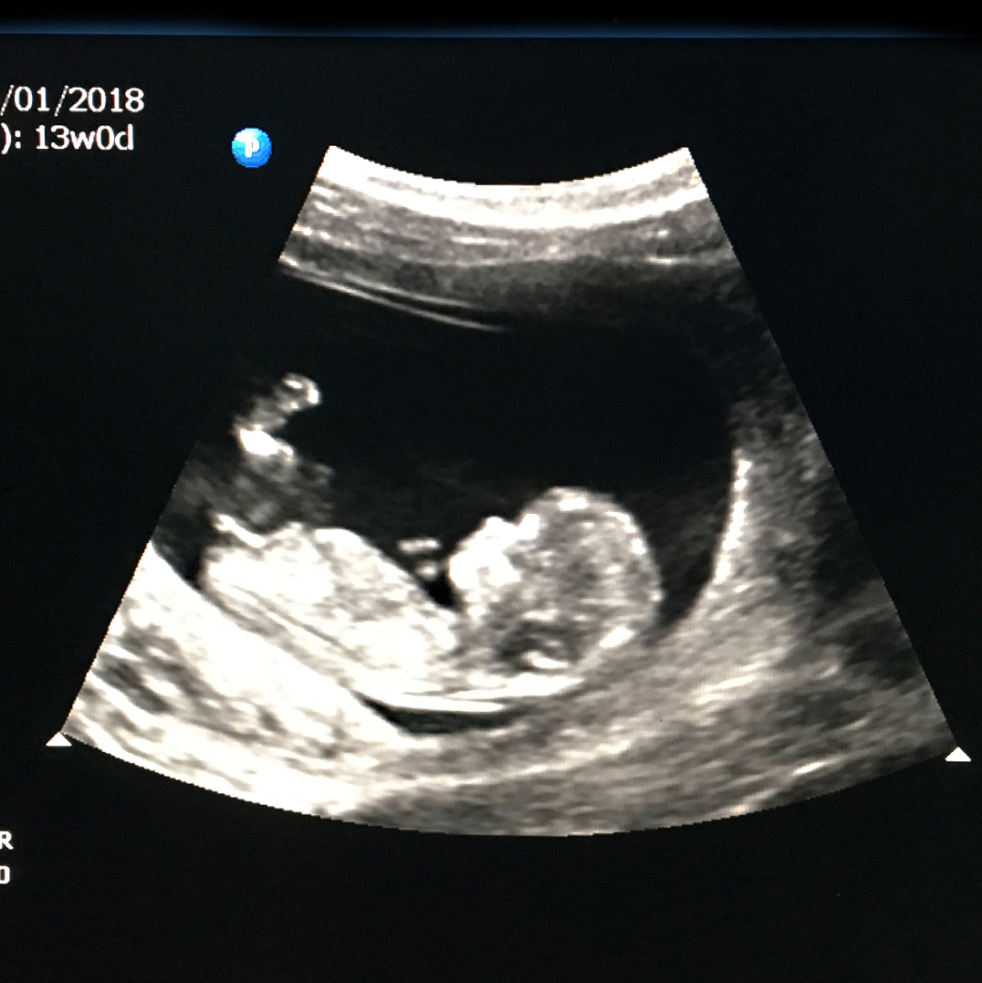 Name:  ultrasound2.jpg
Views: 733
Size:  665.6 KB