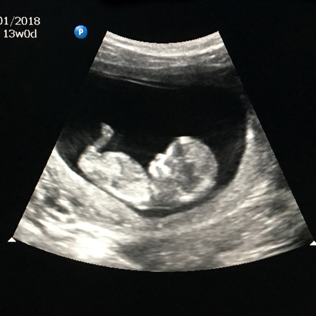 Name:  ultrasound1.jpg
Views: 296
Size:  599.8 KB