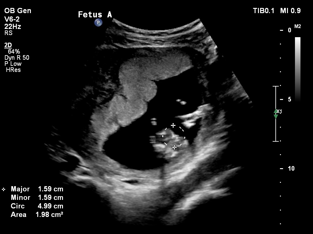 Name:  Baby A gender.jpg
Views: 282
Size:  86.6 KB
