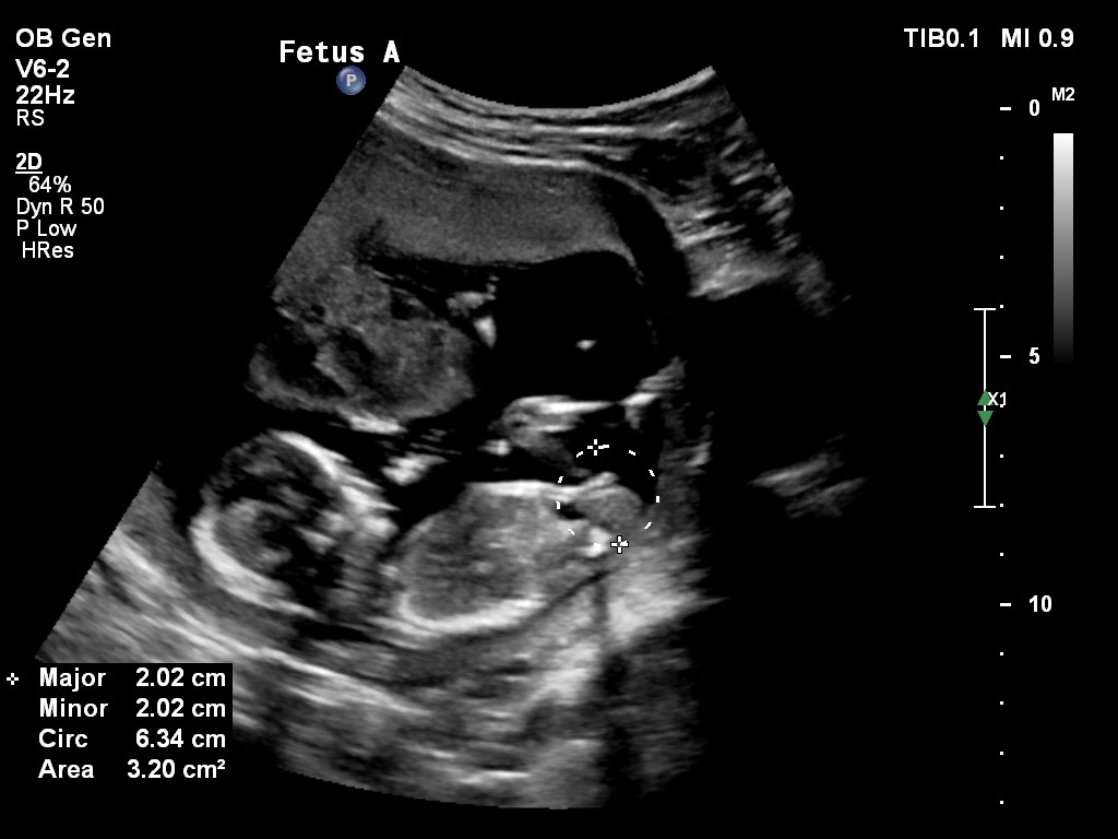 Name:  Baby A nub 14+4.jpg
Views: 226
Size:  94.0 KB