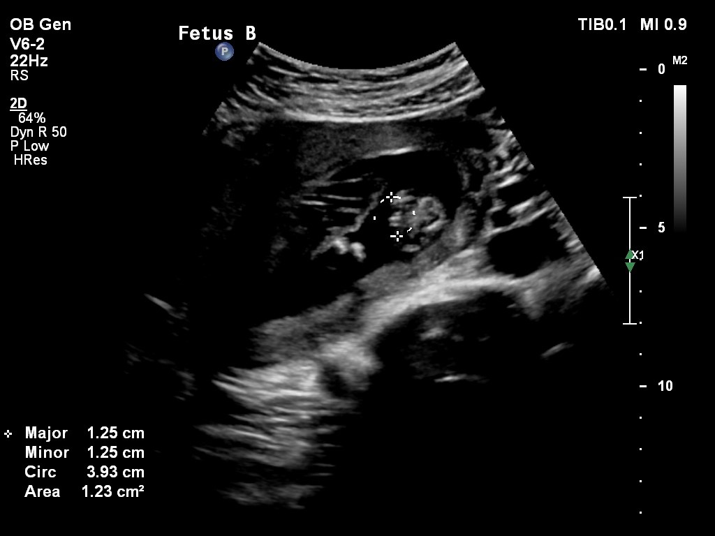 Name:  Baby B gender.jpg
Views: 209
Size:  78.8 KB