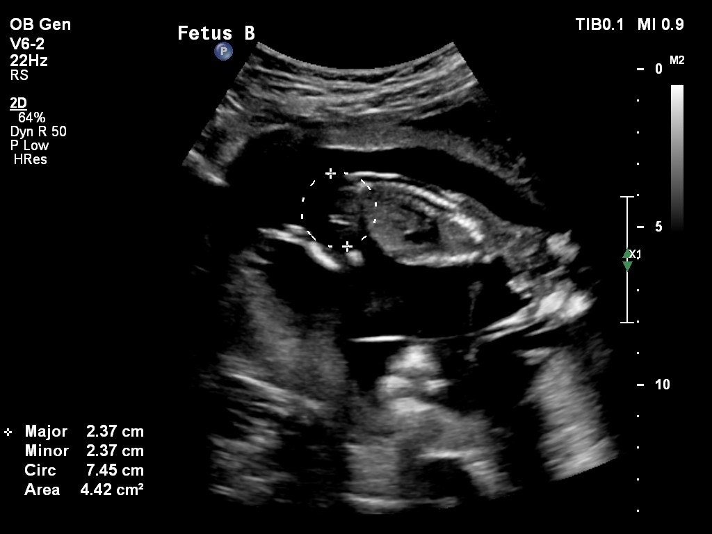 Name:  Baby B nub 14+4.jpg
Views: 198
Size:  89.3 KB