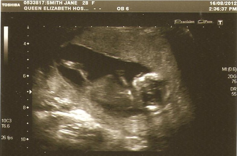 Name:  ultrasound 12 weeks 2 days.jpg
Views: 102
Size:  95.3 KB