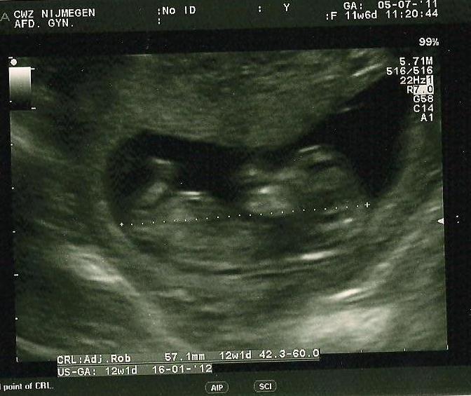 Name:  Nub echo 12wk.jpg
Views: 241
Size:  62.8 KB