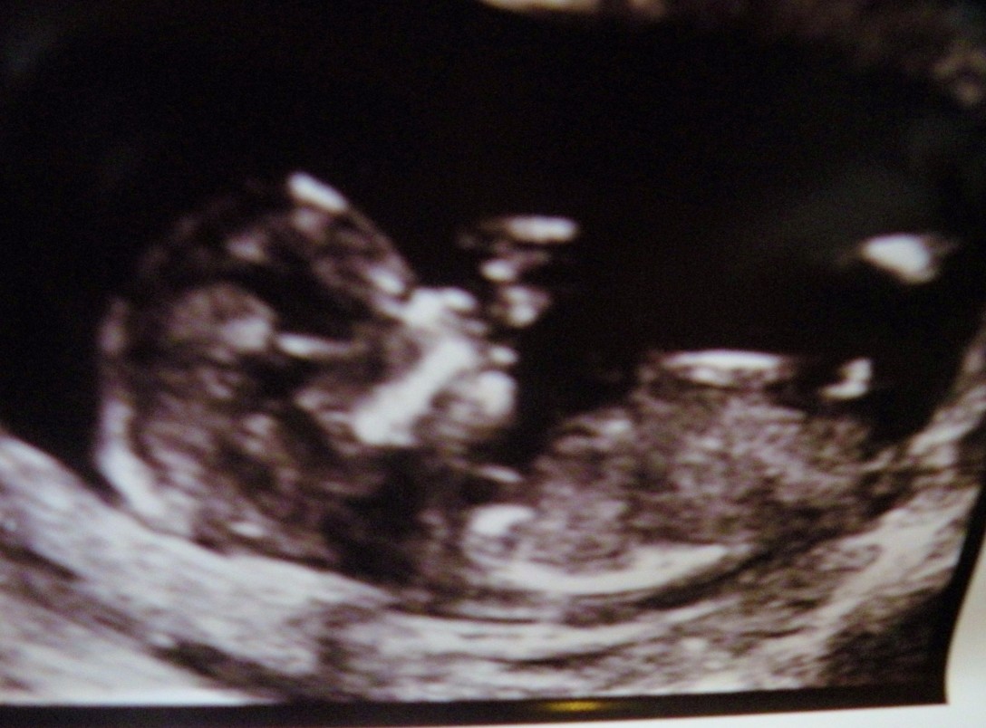 Name:  Baby #4 small profile.jpg
Views: 254
Size:  187.6 KB