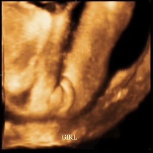 Name:  32wks_girl.jpeg
Views: 126
Size:  23.6 KB