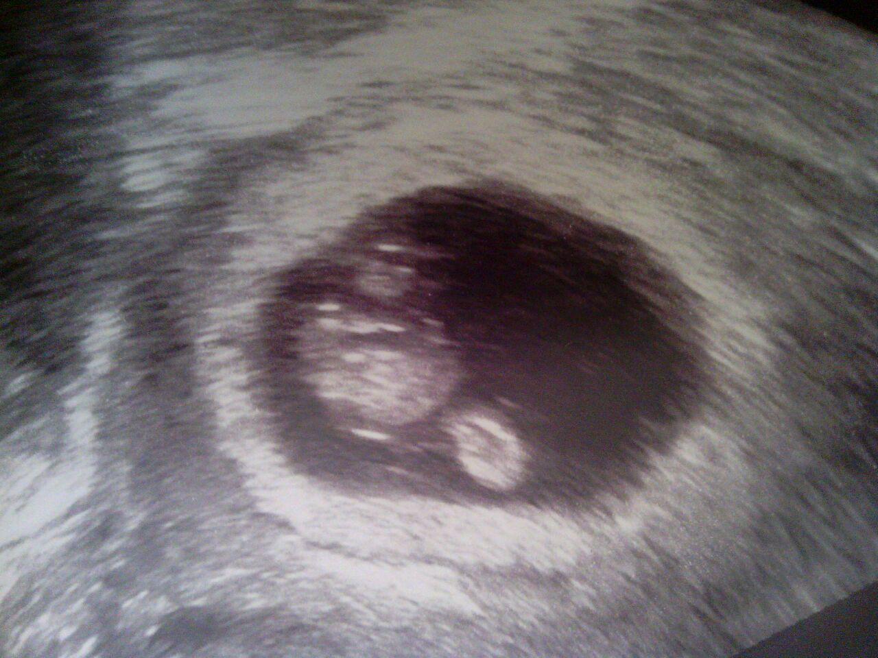 Name:  Haley sonogram April 2013 baby 1.jpg
Views: 140
Size:  171.3 KB