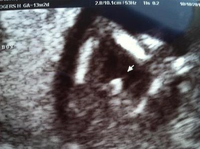 Name:  Haley sonogram April 2013 boy.jpg
Views: 594
Size:  39.9 KB